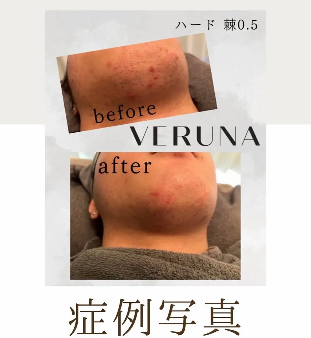 （学割U18）ハーブトリートメント🌿ダウンタイムなし！の写真