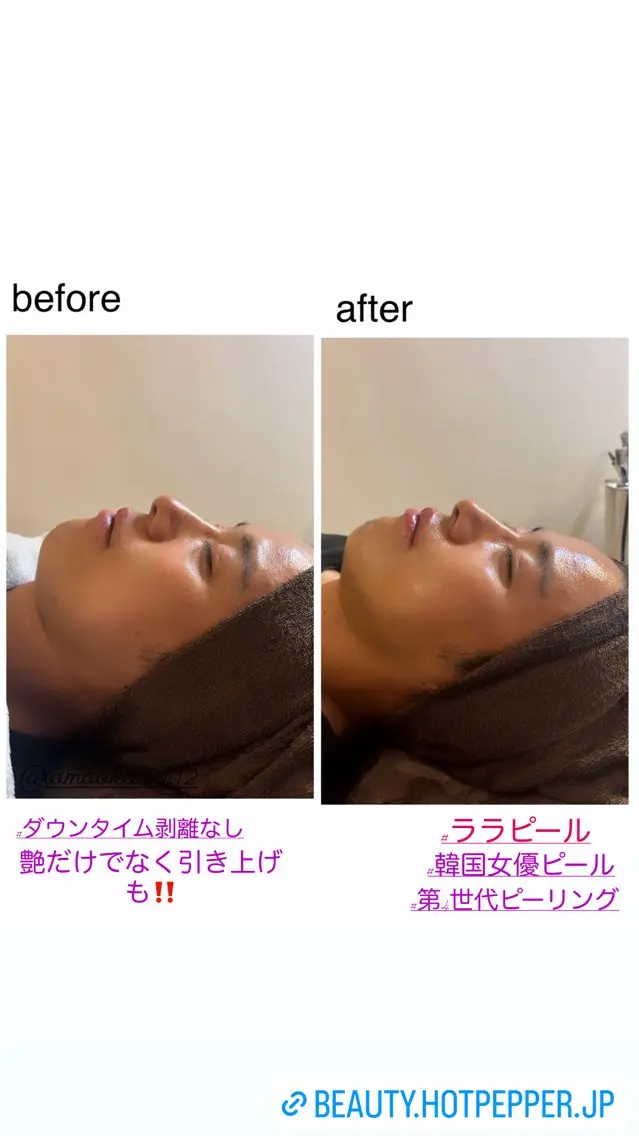 エステ ハーブピーリング専門 毛穴洗浄❤️眉waxのエステ・リラクイメージ
