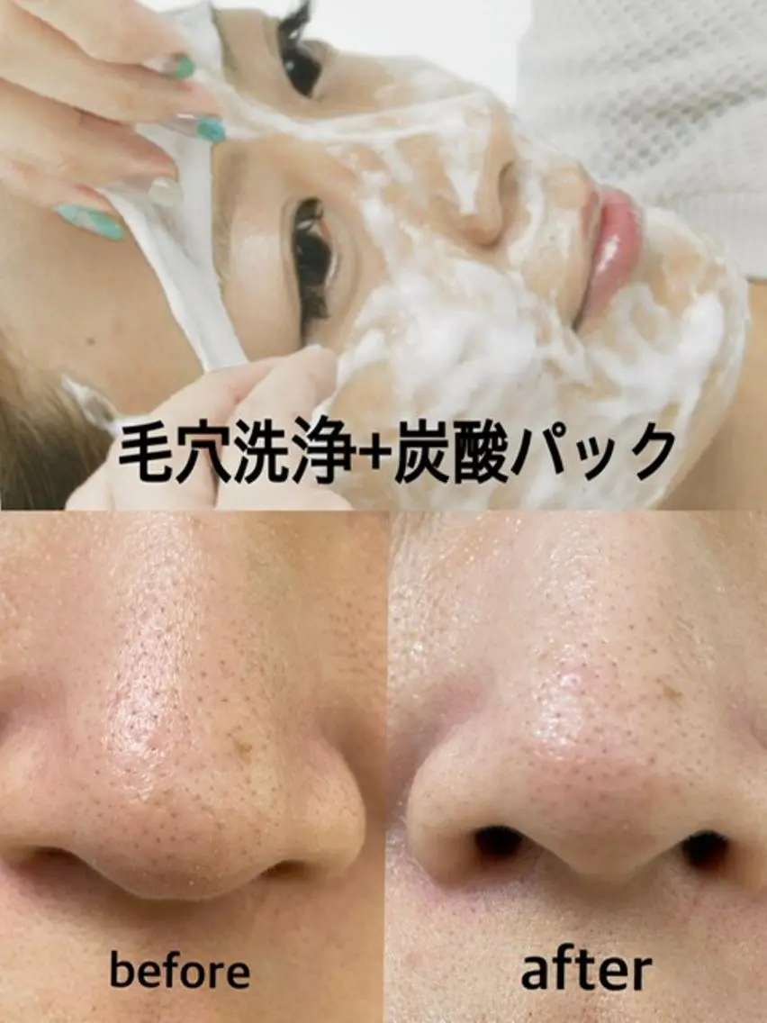 【毛穴×肌トーンUP×保湿】4step全顔毛穴洗浄+濃密美容炭酸パック1回¥6000の写真