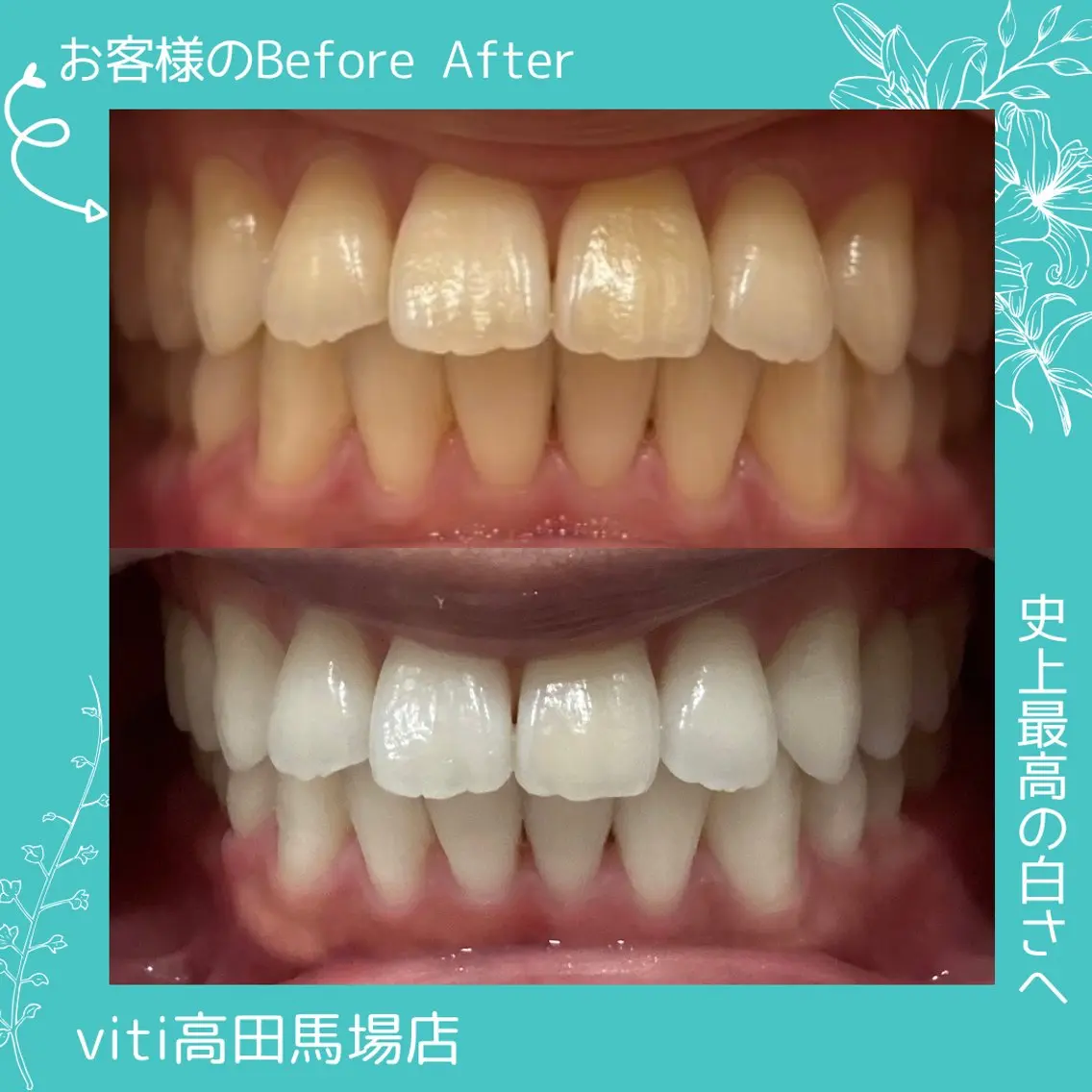 🩵美容🩵セルフホワイトニング20分+カウンセリングの写真