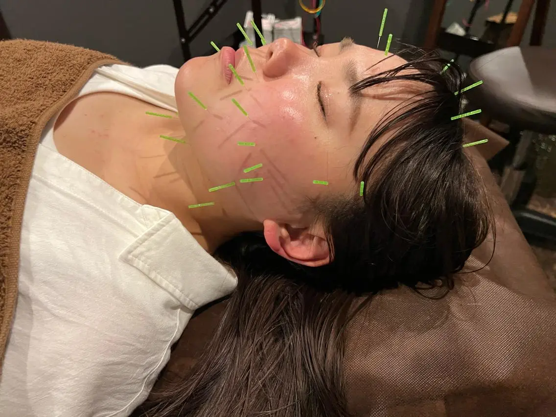 ⭐️平日(10​〜​16時)限定⭐️美容鍼(顔のみ)8800→5000の写真