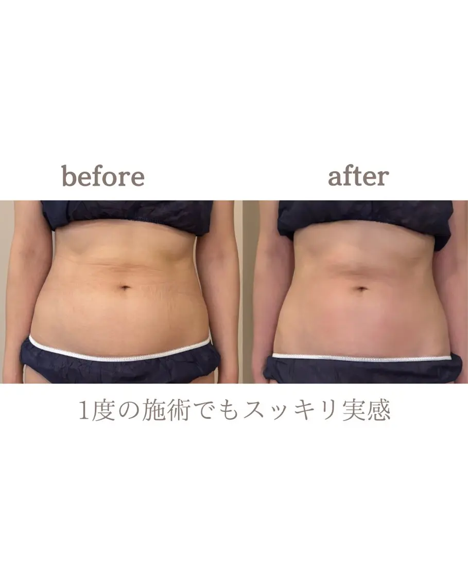 【1日1名まで】整体師が行うお腹やせ高周波トリートメントの写真