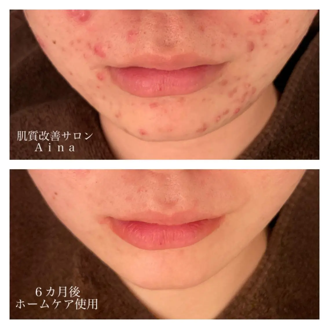 セミロング カラー パーマ ヘアアレンジ メンズ キッズ ネイル マツエク・マツパ 赤色 エステ リラク ニキビ跡専門サロン Ainaのエステ・リラクイメージ