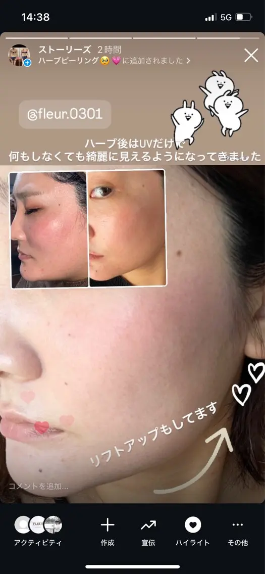 剥離あり🌿全顔ハーブピーリング😆💗医療提携サロン🫶肌を育てる喜びを🫶の写真