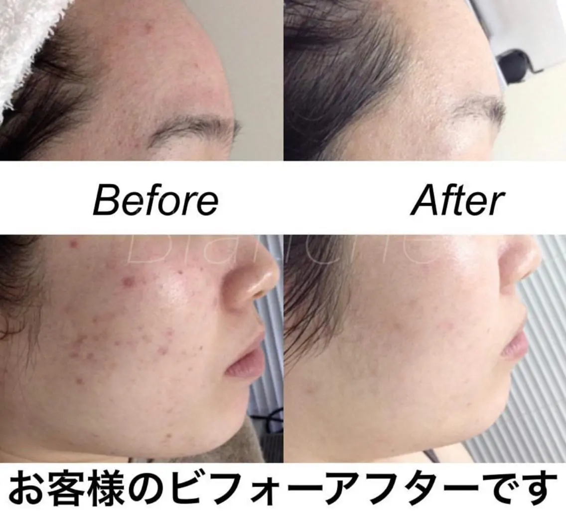 セミロング カラー パーマ ヘアアレンジ キッズ ネイル マツエク・マツパ エステ リラク 都度払い肌質改善 &脱毛Blancheのエステ・リラクイメージ