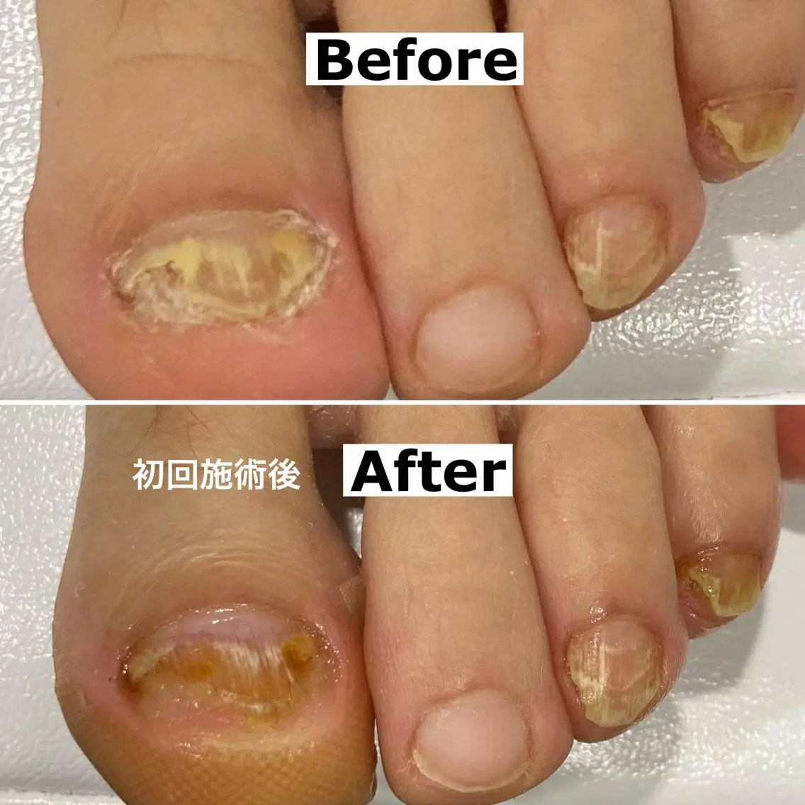 ネイル 巻爪無料モデル募集 ✨🦶MEGUMIのネイルデザイン