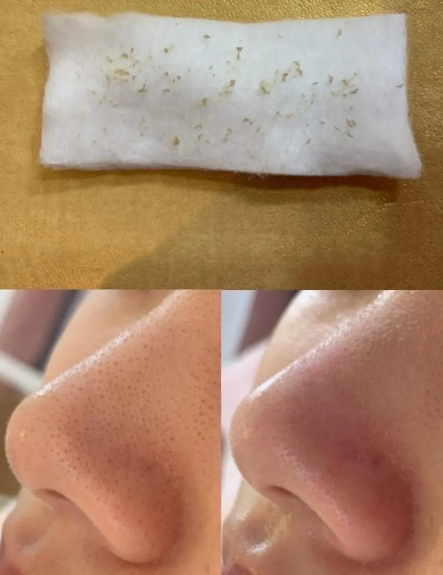 【毛穴エクストラクション】何をしても取れなかった毛穴の詰まりを優しく取り除きます✨の写真