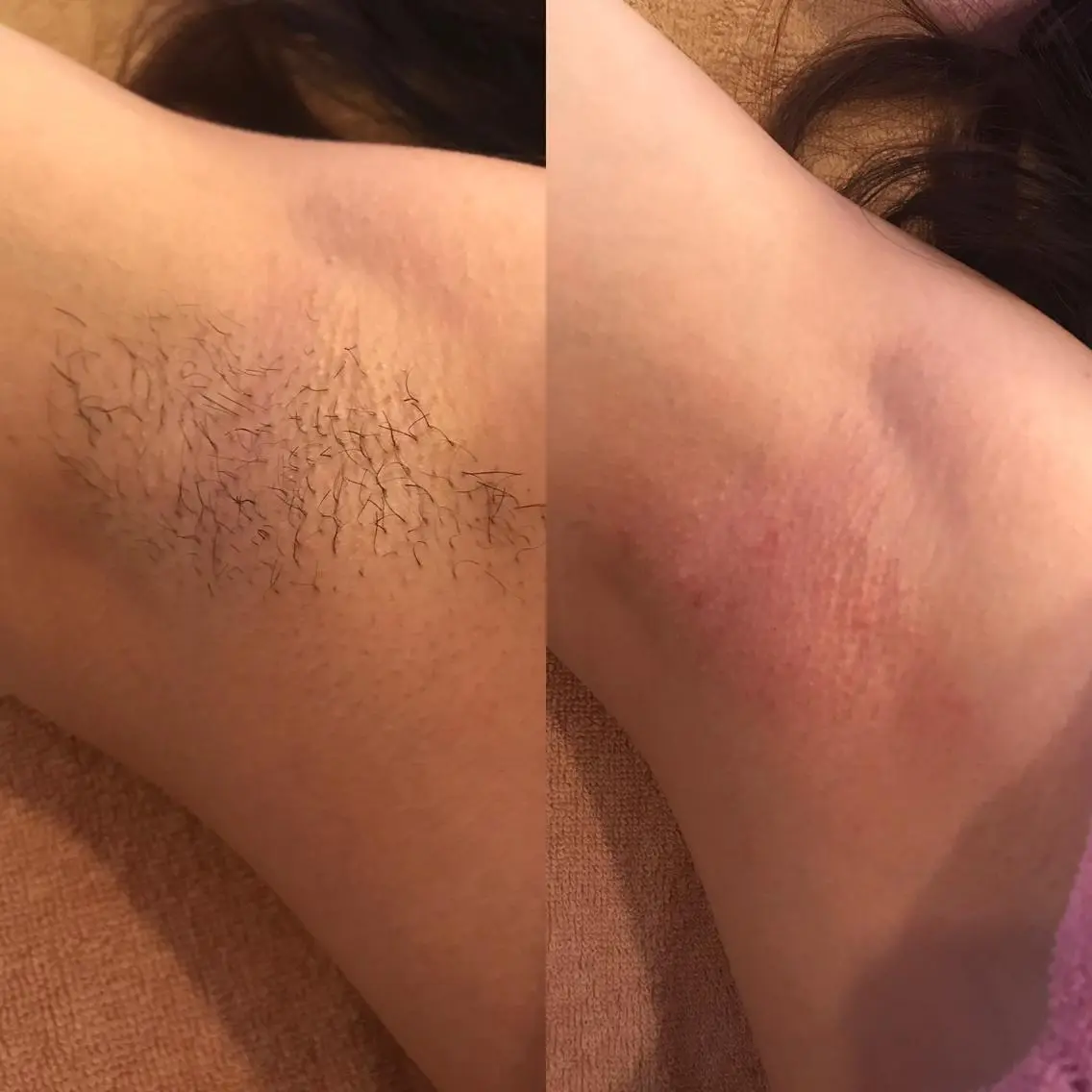【黒ずみ対策期待◉】ワックス脱毛 両脇 ＋ 保湿ジェル付きの写真