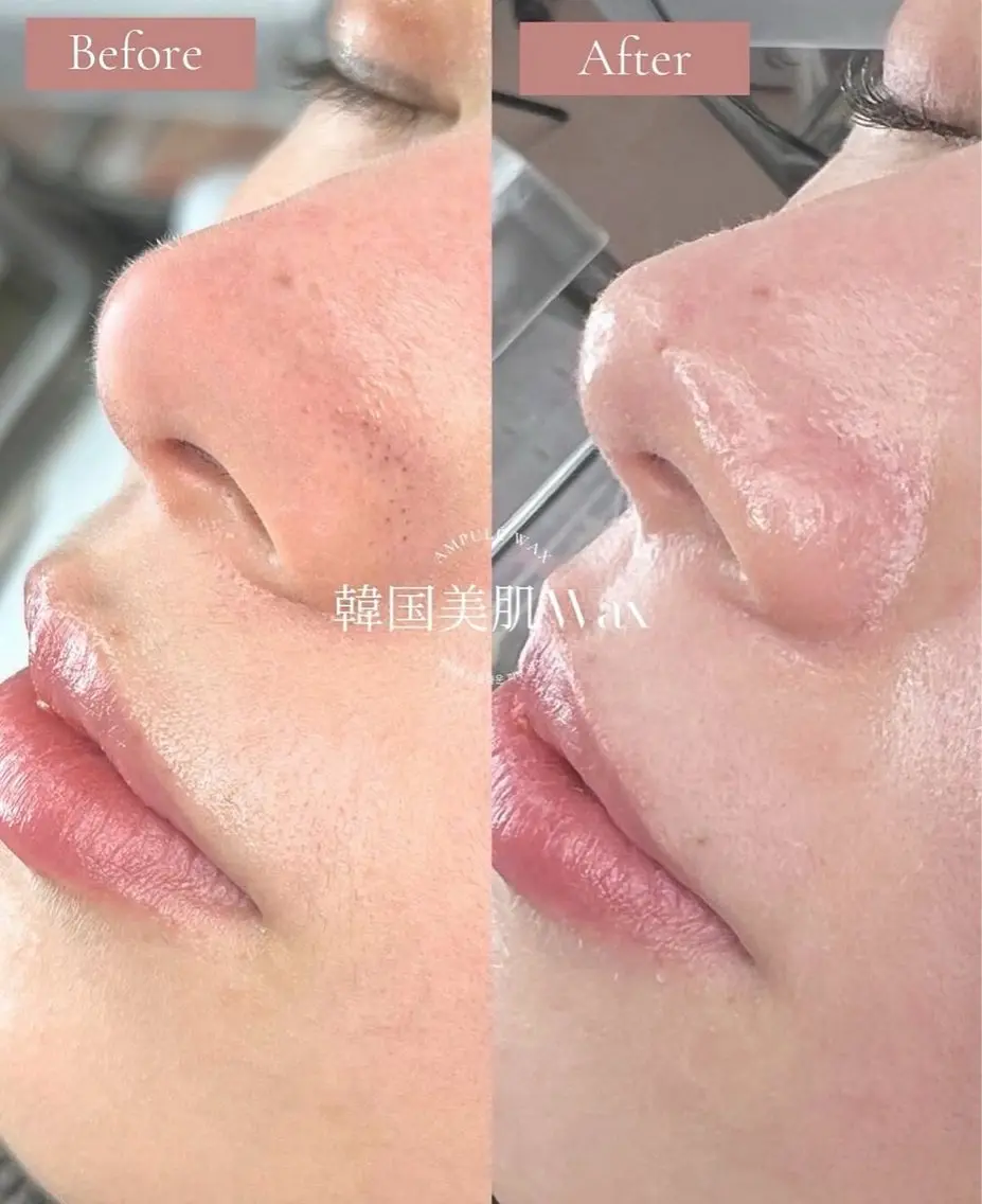 韓国美肌Wax おでこ、口周り、鼻、顎、頬の全顔コース!美容液たっぷりのフェイスWax★の写真