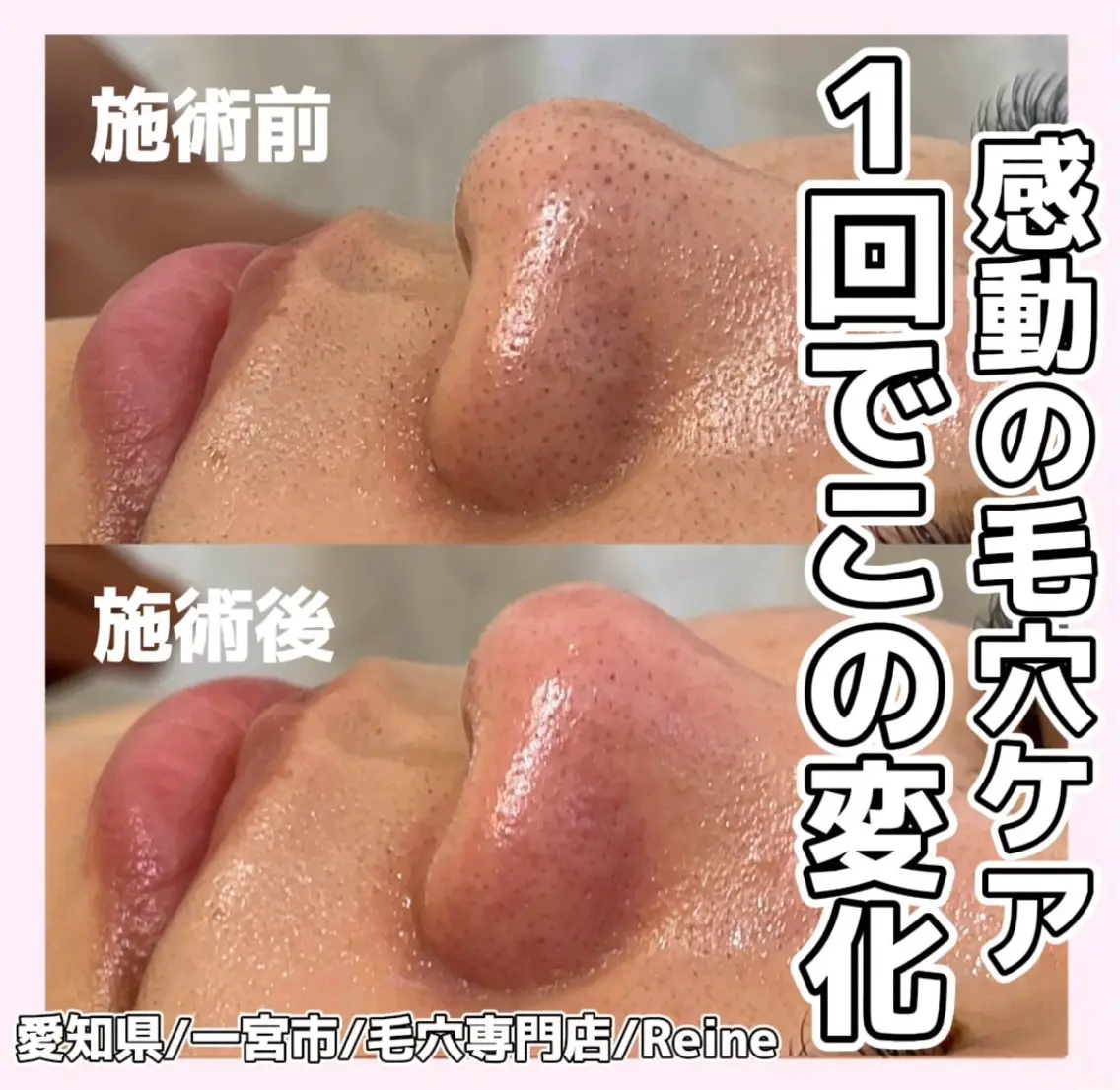 毛穴/シミ肝斑/脱毛 横山梨里のエステ・リラクイメージ