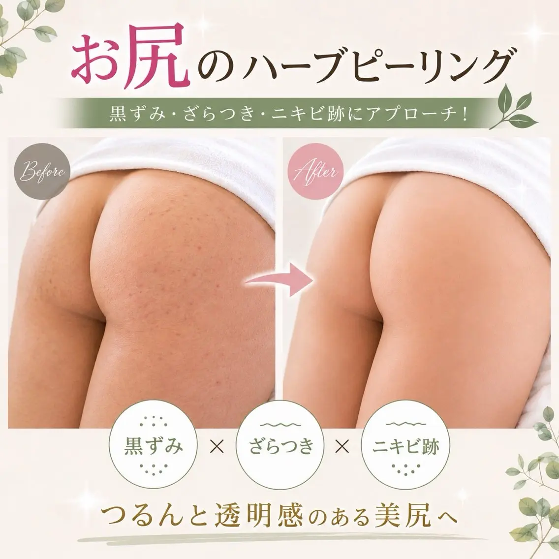 【おしり🍑ピーリング】繰り返すニキビ・ニキビ跡にハーブ🌿ピーリング❣️でつるつるヒップ🍑の写真