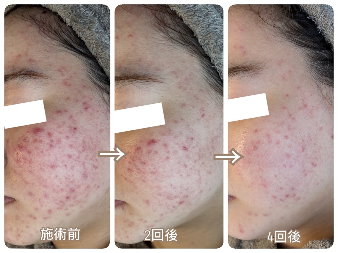 エステ ハーブピーリング 専門店Kikkaのエステ・リラクイメージ