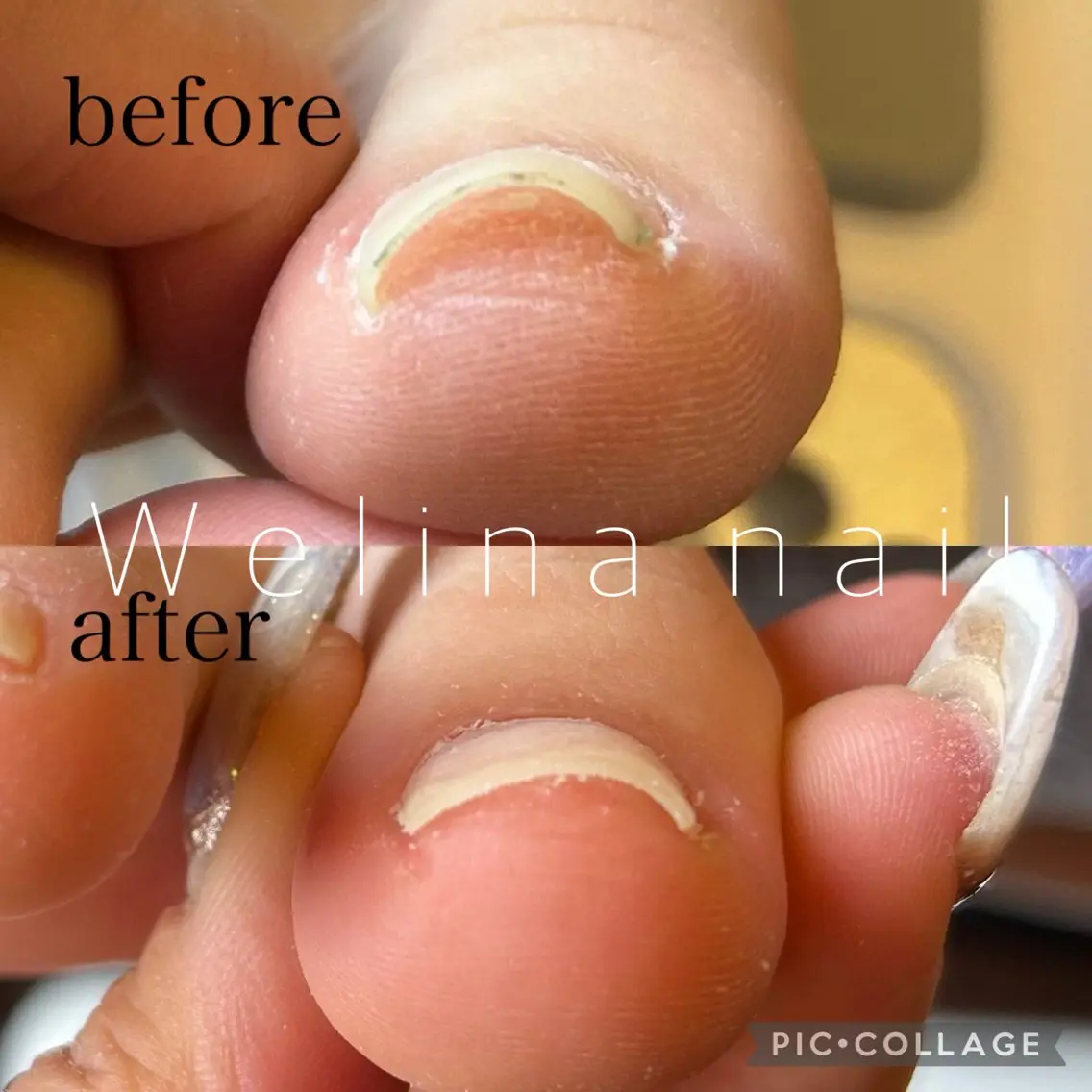 フットネイル/巻き爪ケア+ワンカラーの写真