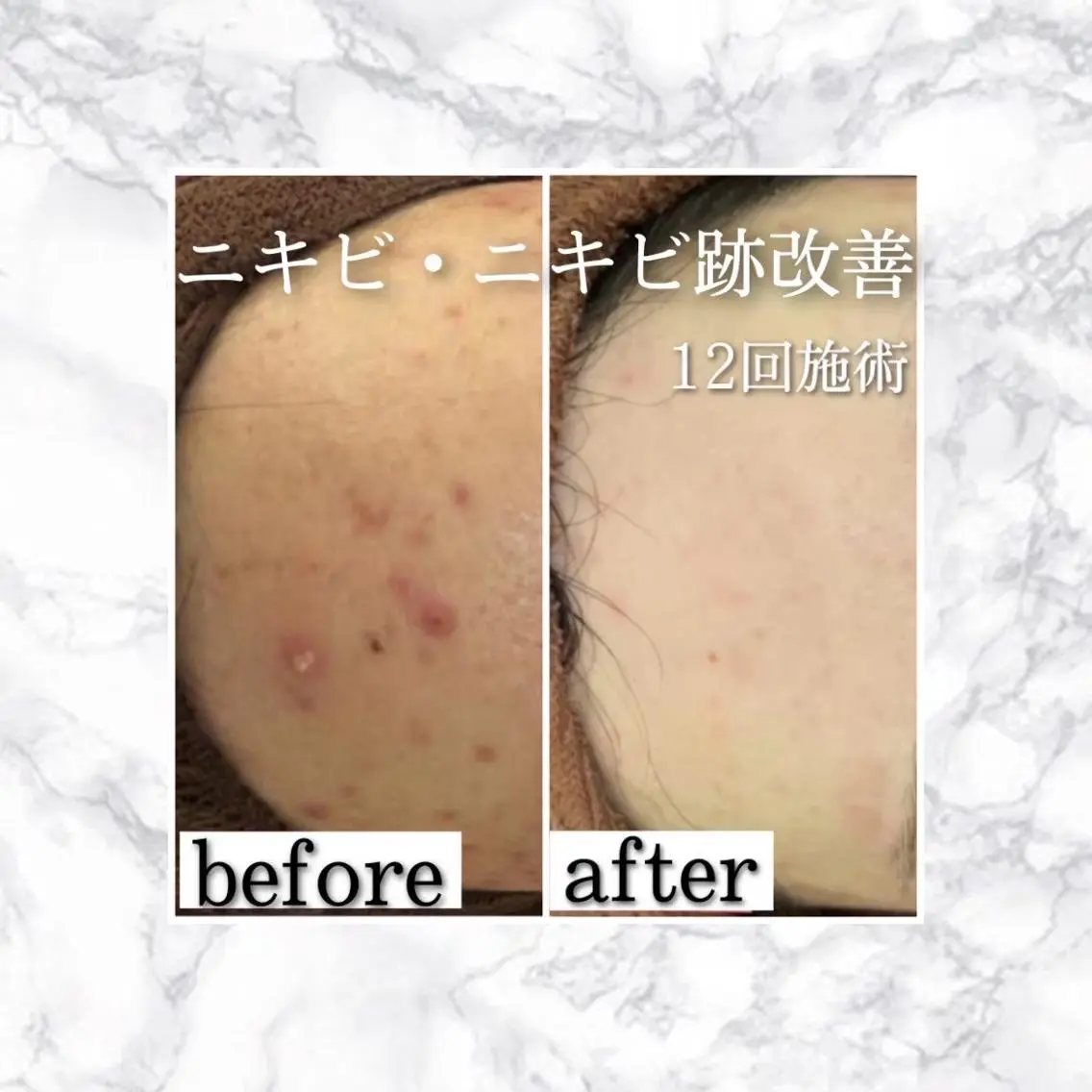エステ リラク 3か月で肌革命👼 ニキビ専門店💫のエステ・リラクイメージ