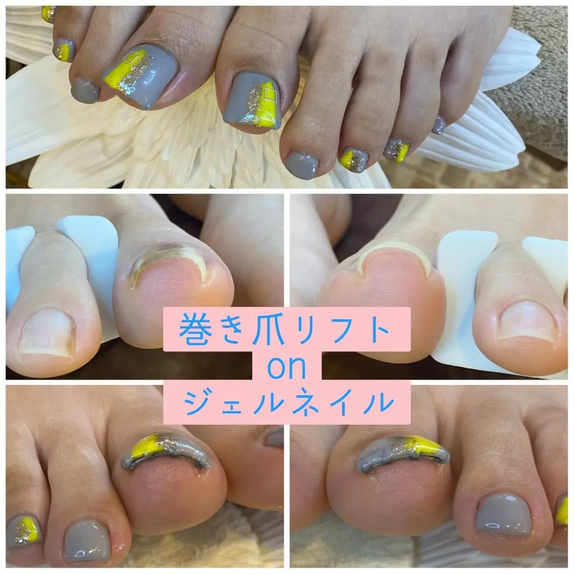 ネイル ジェルネイル ♢ME2ROOM♢ #巻き爪#リラクのネイルデザイン