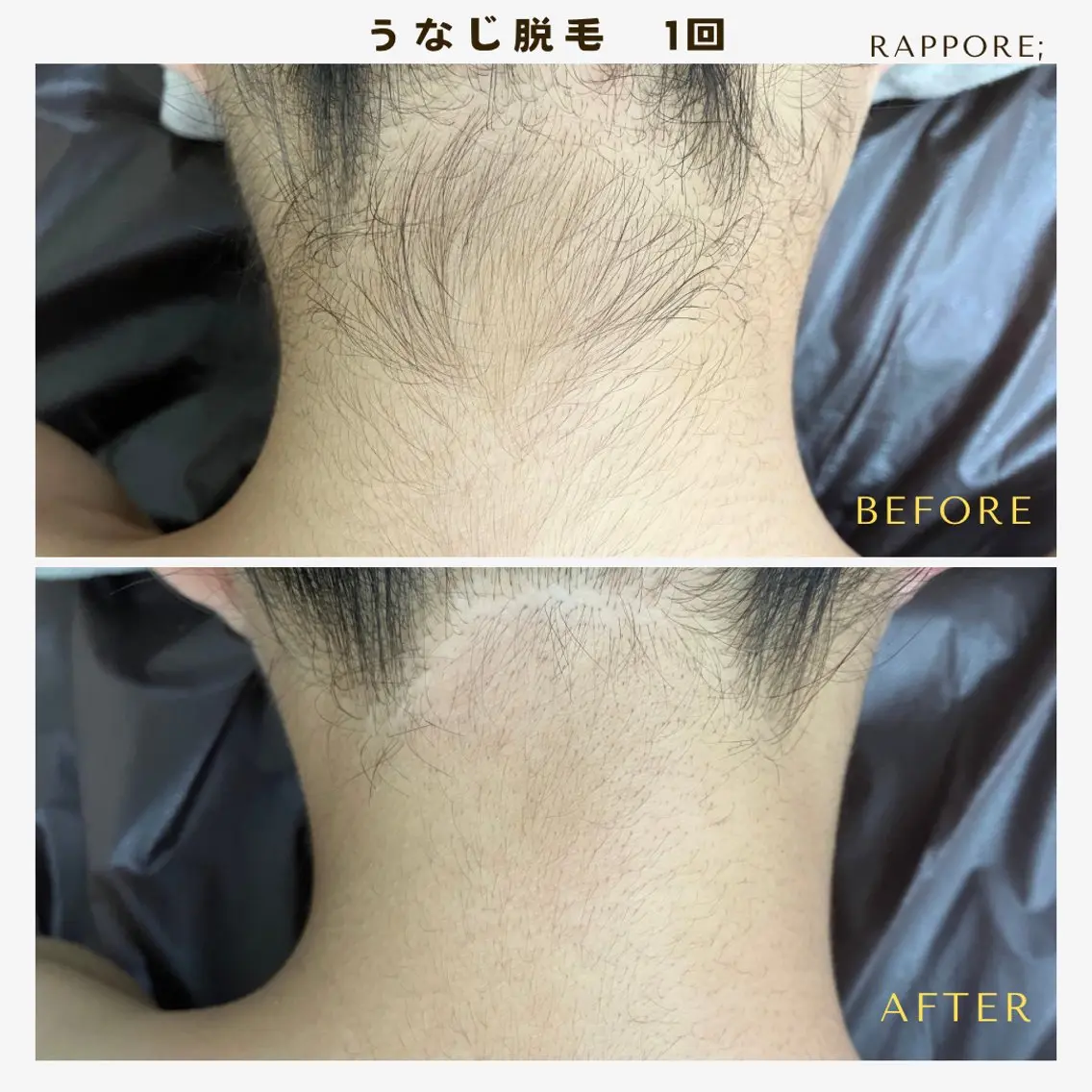 レディースうなじ脱毛✨✨の写真