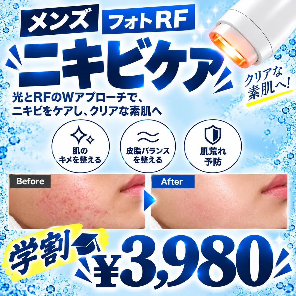 【ミニモ学割U24】フォトRF肌質改善 ニキビケア ¥3,980✨の写真