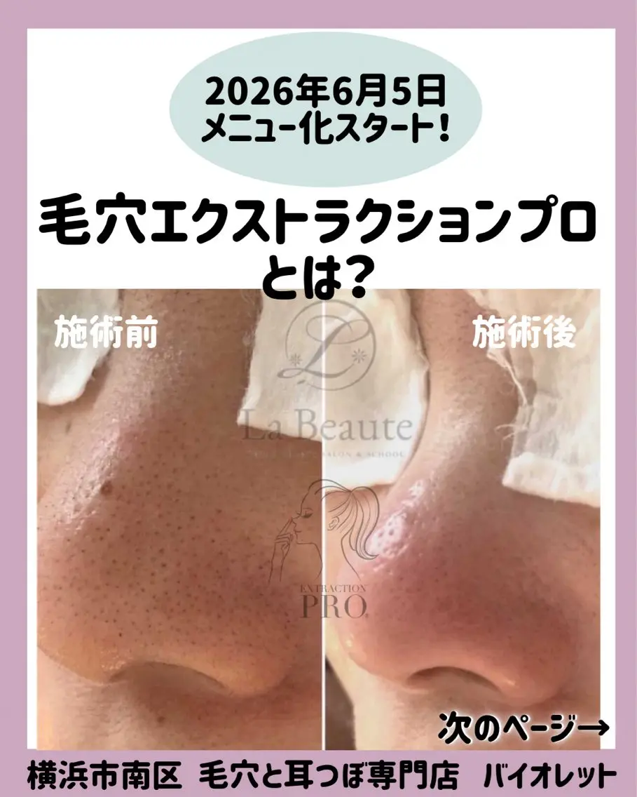 【６月限定】毛穴美人コース＆耳つぼジュエリー４粒　　◆毛穴特化スキンケアサンプル1200円分プレゼント◆の写真