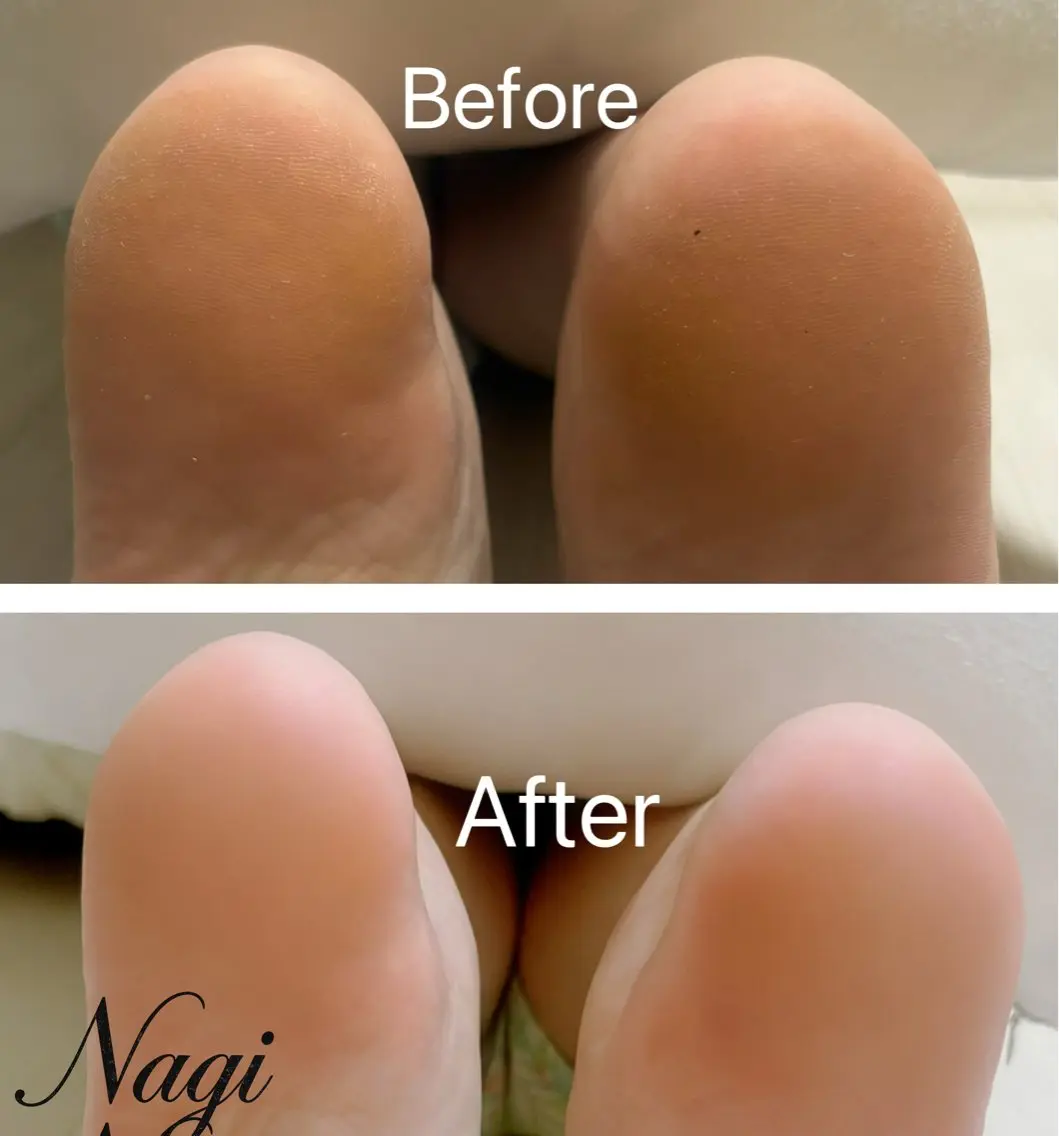 角質ケア、フットケアの写真