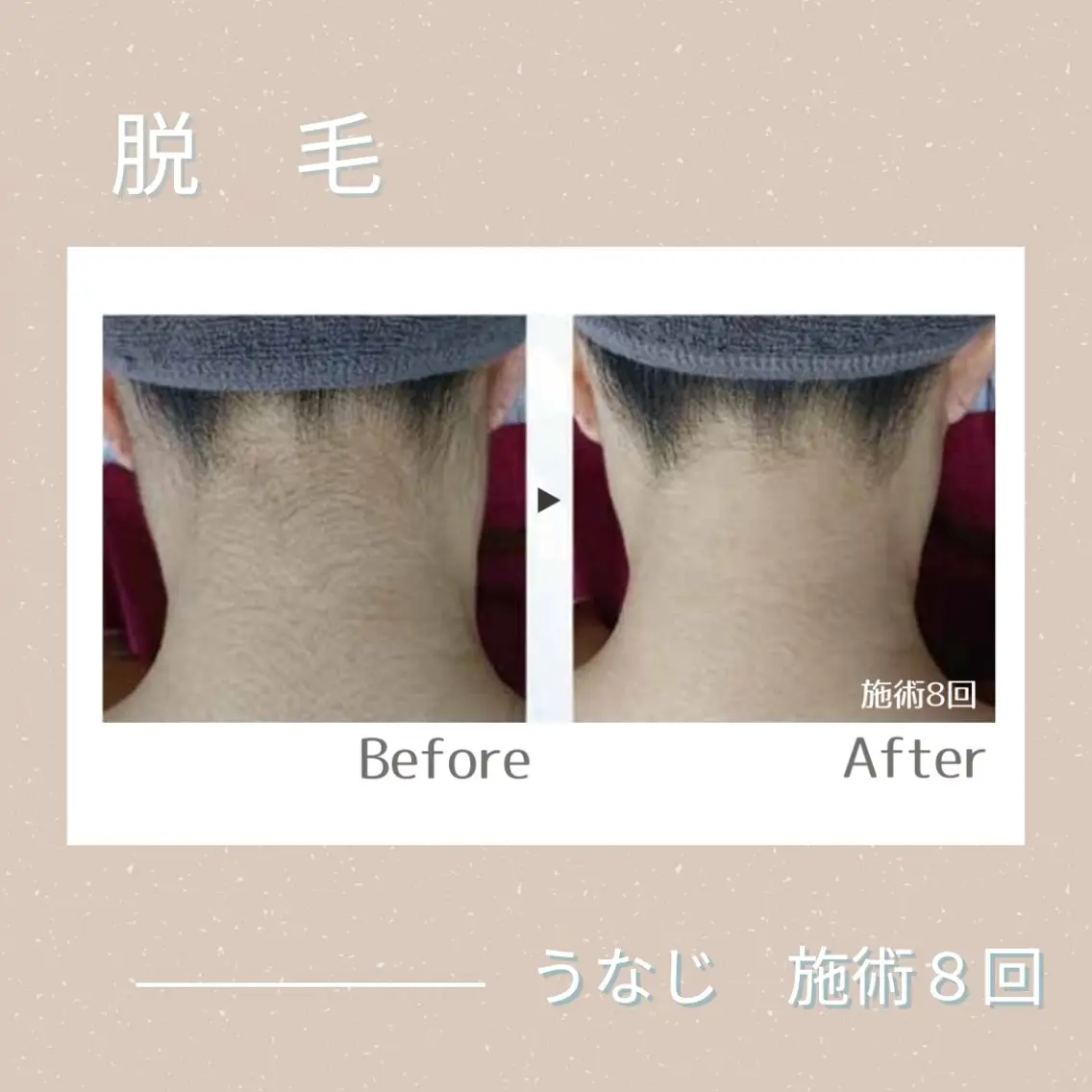 うなじ脱毛の写真