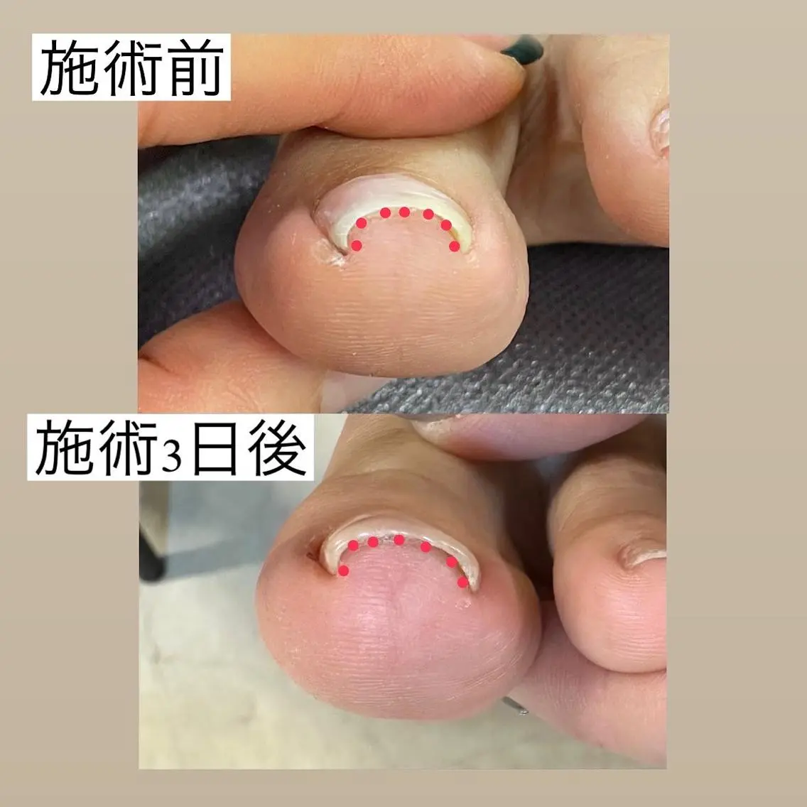 巻き爪モニター様募集（両足親指のみ）男性でも女性でも◎の写真