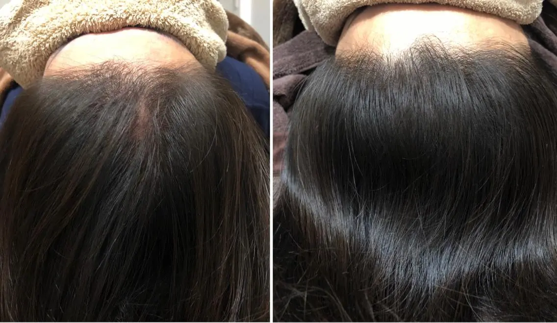 ★特別メニュー★ヘアケアスペシャル頭皮鍼の写真
