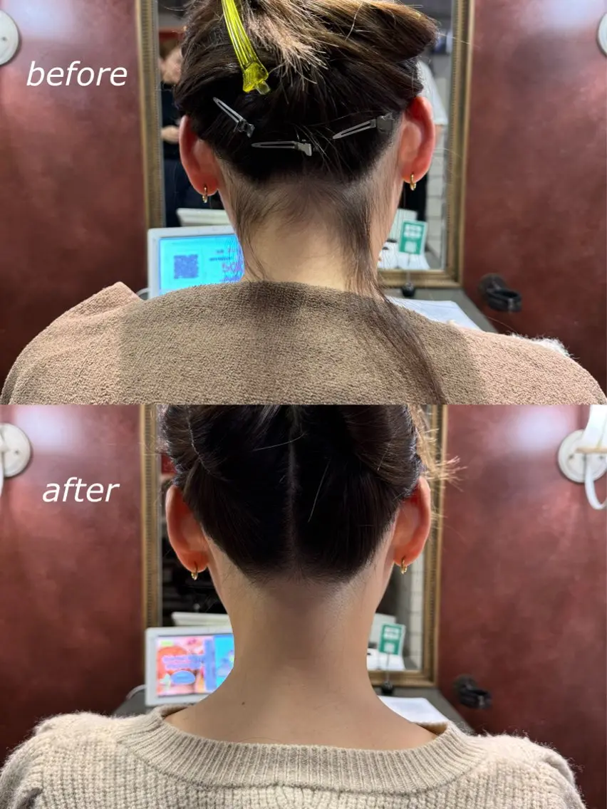 襟足+うなじ脱毛の写真
