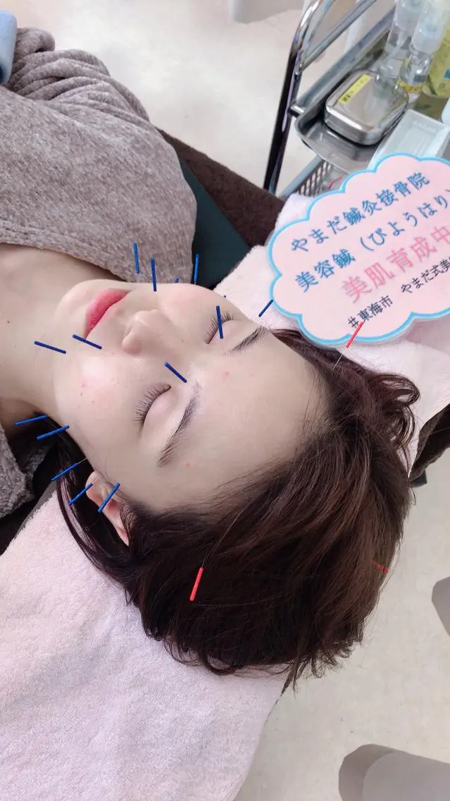 初回美容鍼ベーシックコース（美容鍼コース初回1000円OFF）の写真