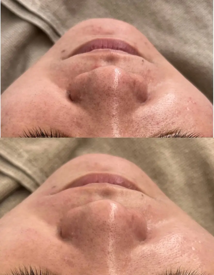 【ミニモ学割】🌀毛穴洗浄🌀水素ピーリングで毛穴の黒ずみスッキリ👃✨の写真