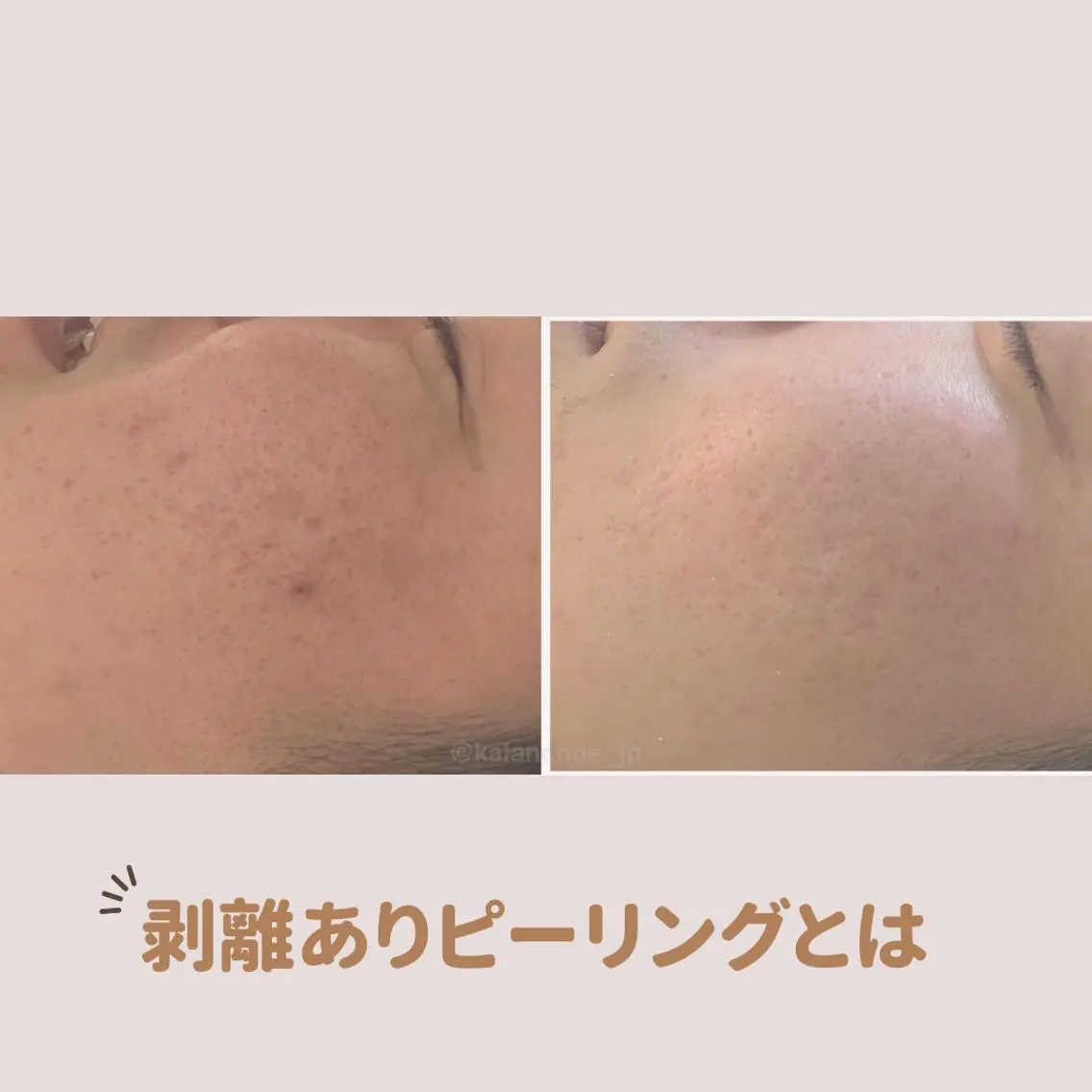 エステ 肌質改善 KALANCHOEのエステ・リラクイメージ