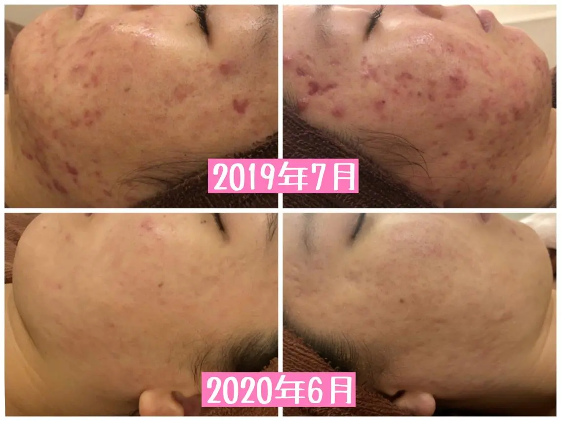 ミディアム カラー パーマ ヘアアレンジ メンズ キッズ ネイル マツエク・マツパ エステ リラク ニキビ・肌質改善専門 ♡人生が変わるサロンのエステ・リラクイメージ