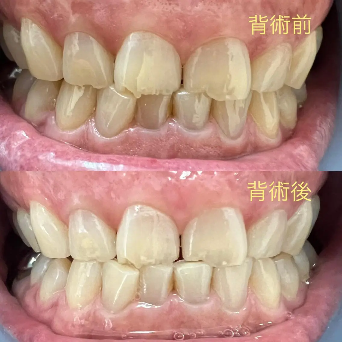 セルフホワイトニング初回の写真