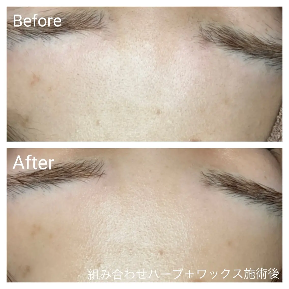 ⭐️お悩み別に施術⭐️肌育ハーブピーリング+フェイスワックス90分の写真