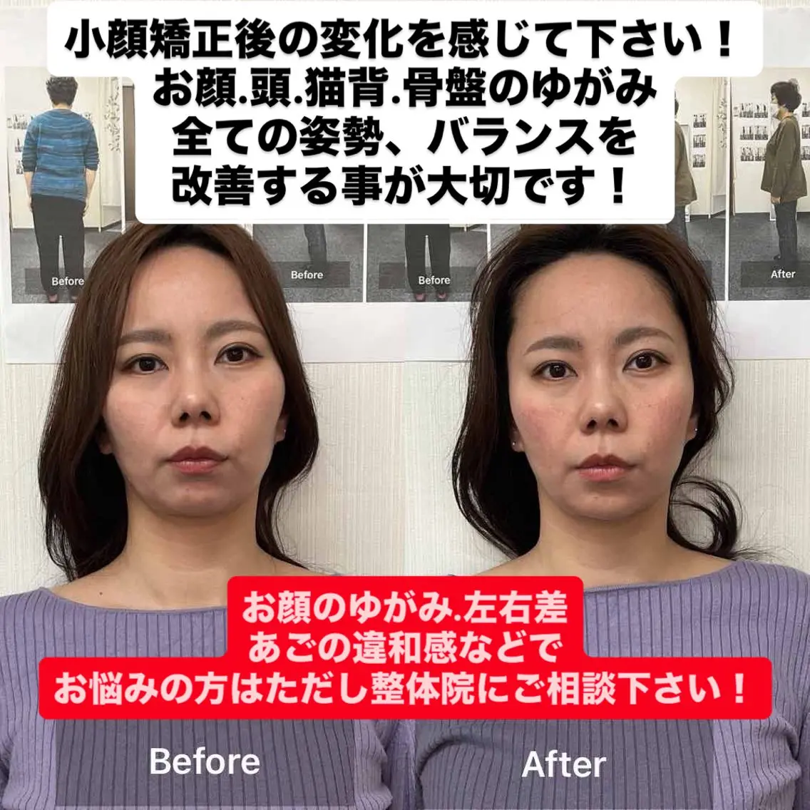 小顔矯正の写真