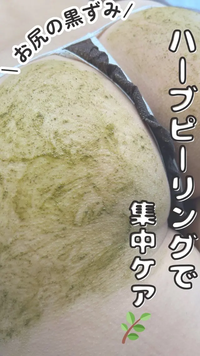 初回お試し💎【体1部位】剥離ありハーブピーリング🌿（背中上・下・お尻・二の腕・デコルテ）ニキビ・ニキビ跡・ぷつぷつの写真
