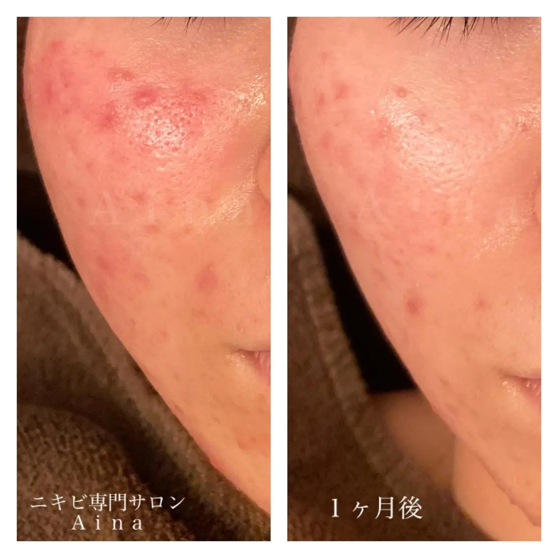 セミロング カラー パーマ ヘアアレンジ メンズ キッズ ネイル マツエク・マツパ ジェルネイル 赤色 ニキビ跡専門サロン Ainaのエステ・リラクイメージ