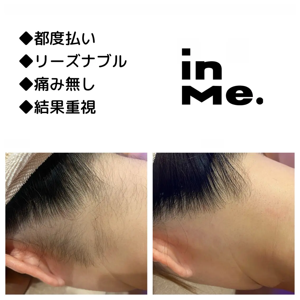 メンズ キッズ 脱毛 ◆つど払い脱毛◆ in Me.インミーのエステ・リラクイメージ