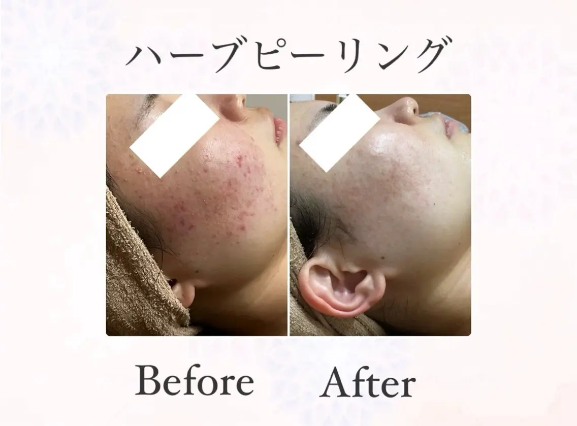 【ハーブピーリング】ニキビ,毛穴に🩵剥離無しハーブピーリング&毛穴洗浄&パック付💆🏻♀️根本改善したい方へ✨の写真