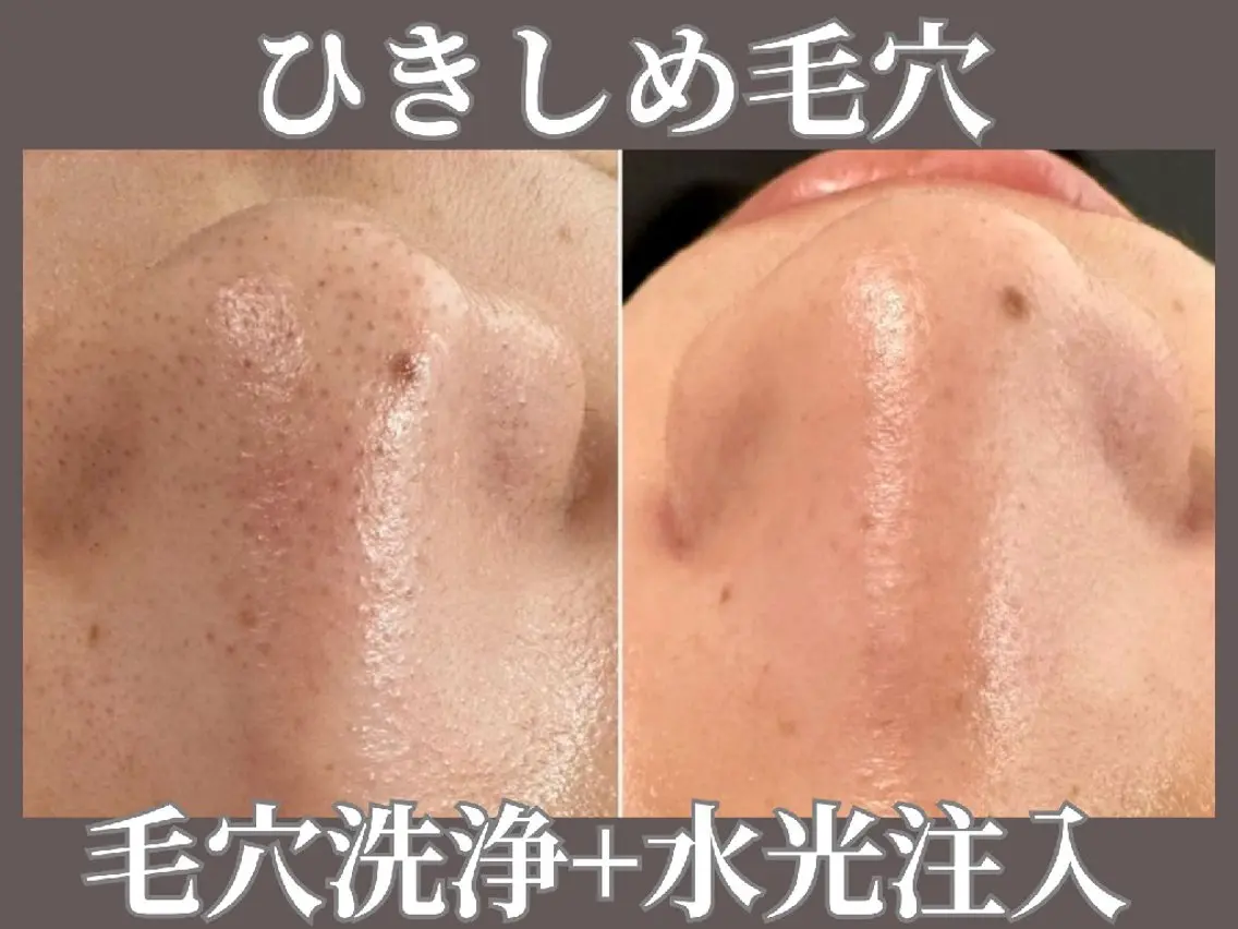 毛穴洗浄ハイドロフェイシャル(顔全体)+針なし水光の写真