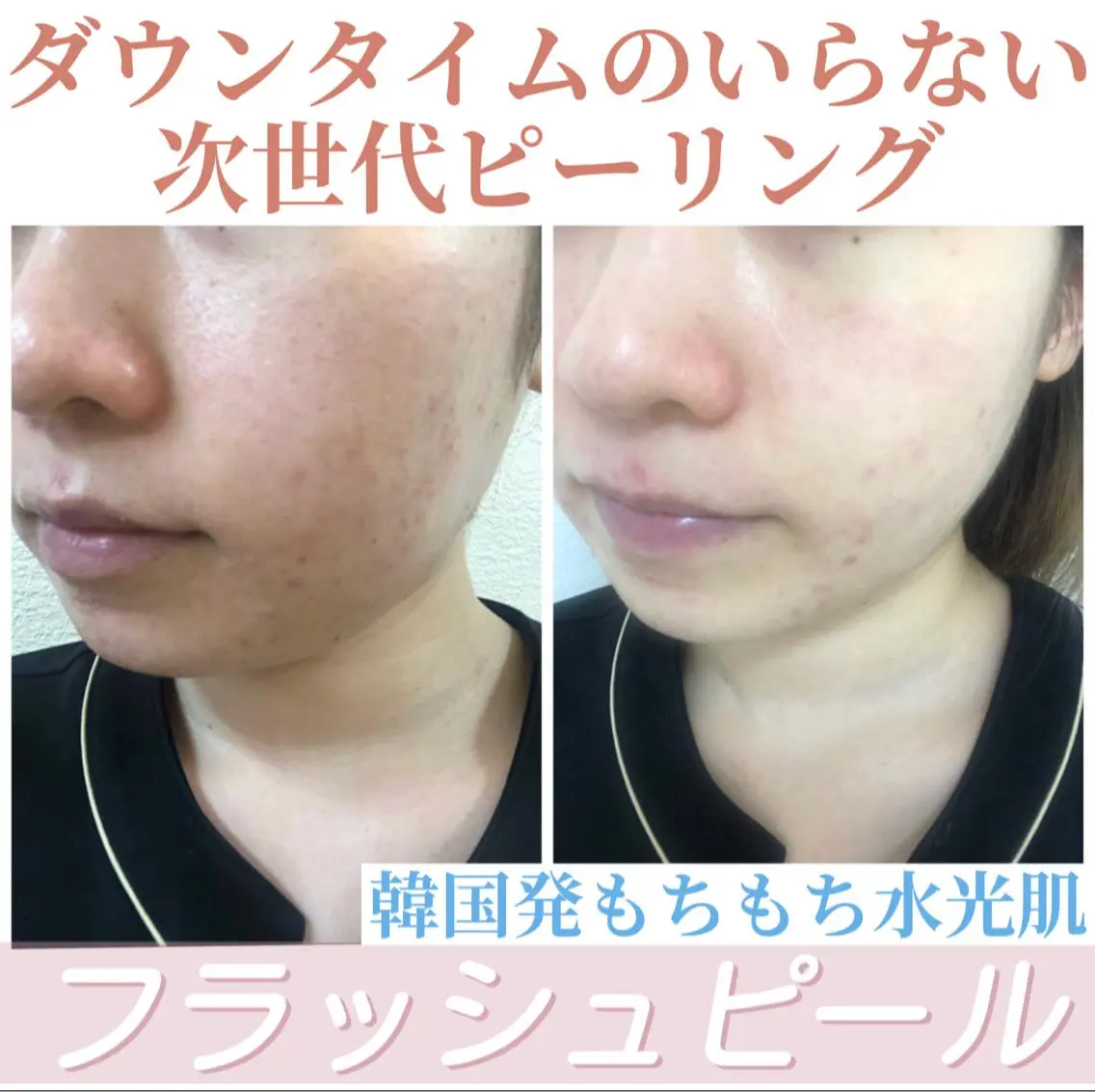 大人気💎韓国クリニック発ダウンタイム無しのピーリング！美白・ニキビ・エイジングお悩み別にピーリングできます🤍の写真