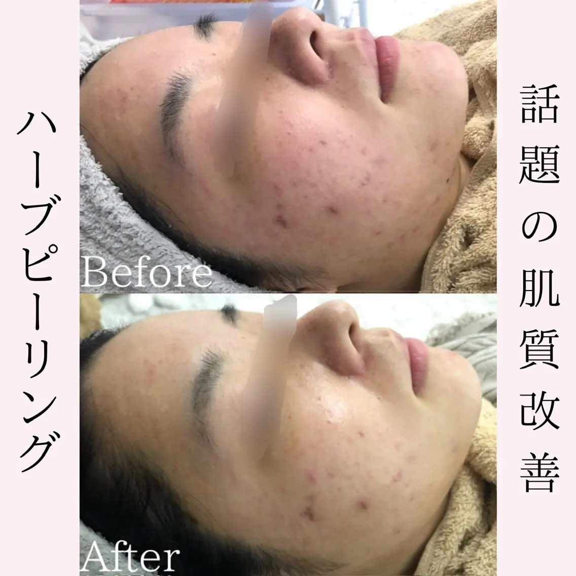 エステ BestBelleꕤ 大阪福島/肌質改善のエステ・リラクイメージ