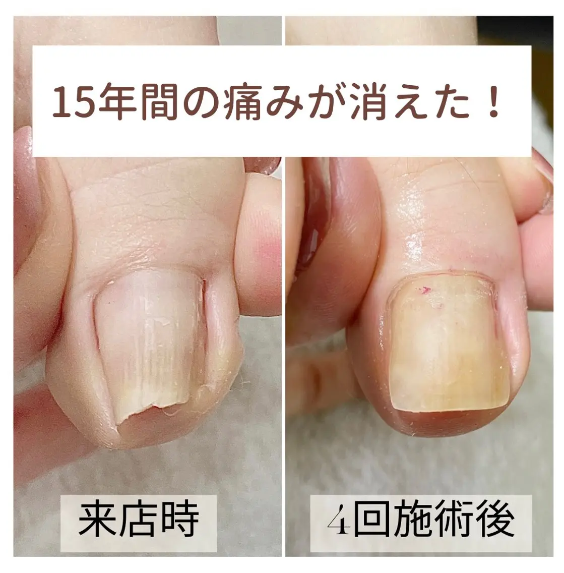 ネイル 巻き爪・肥厚爪ケア 専門サンセリテのネイルデザイン