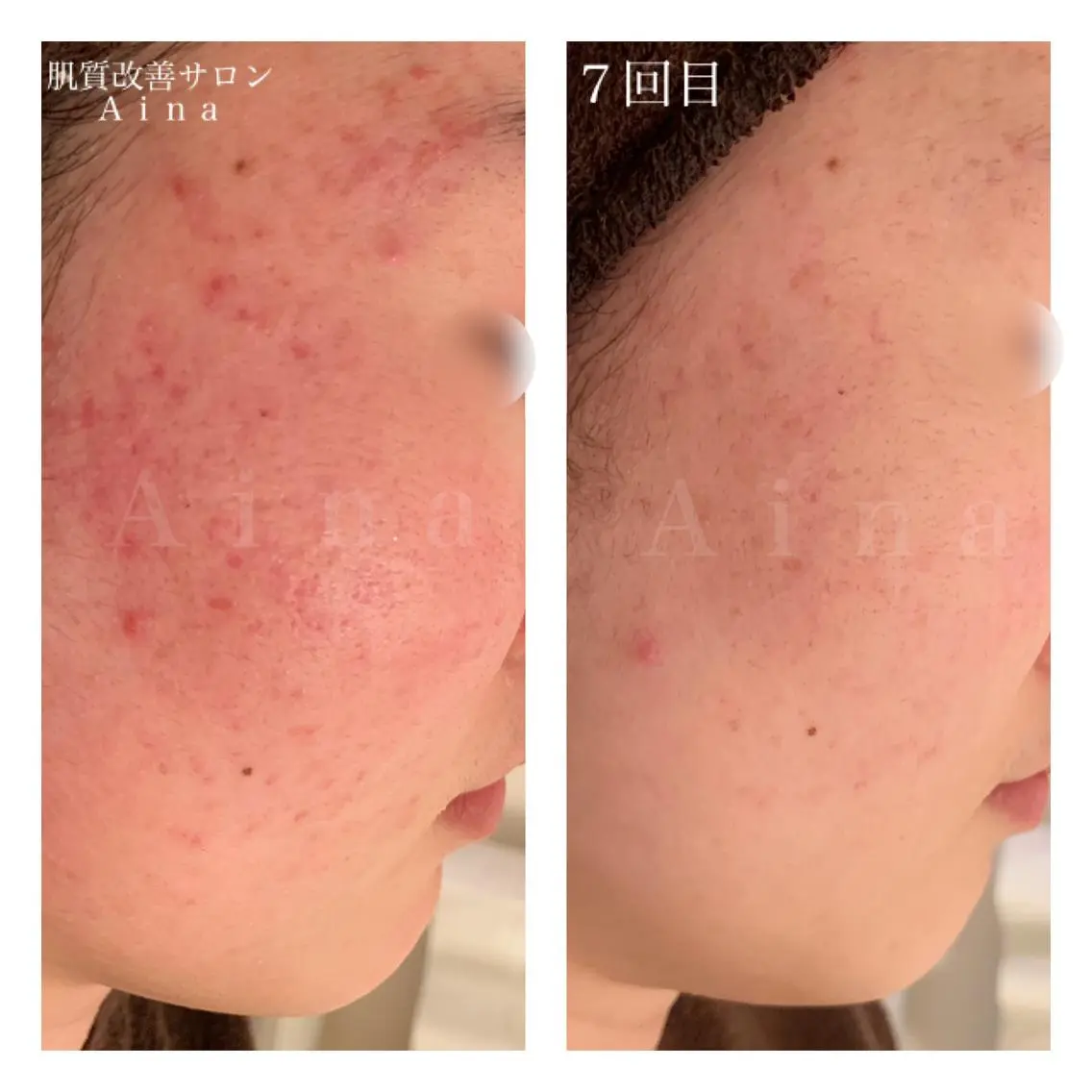 セミロング カラー パーマ ヘアアレンジ メンズ キッズ ネイル マツエク・マツパ ニキビ跡専門サロン Ainaのエステ・リラクイメージ