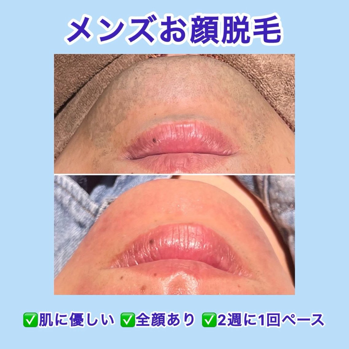 脱毛 Folche 春日 岡田 🌷︎のエステ・リラクイメージ