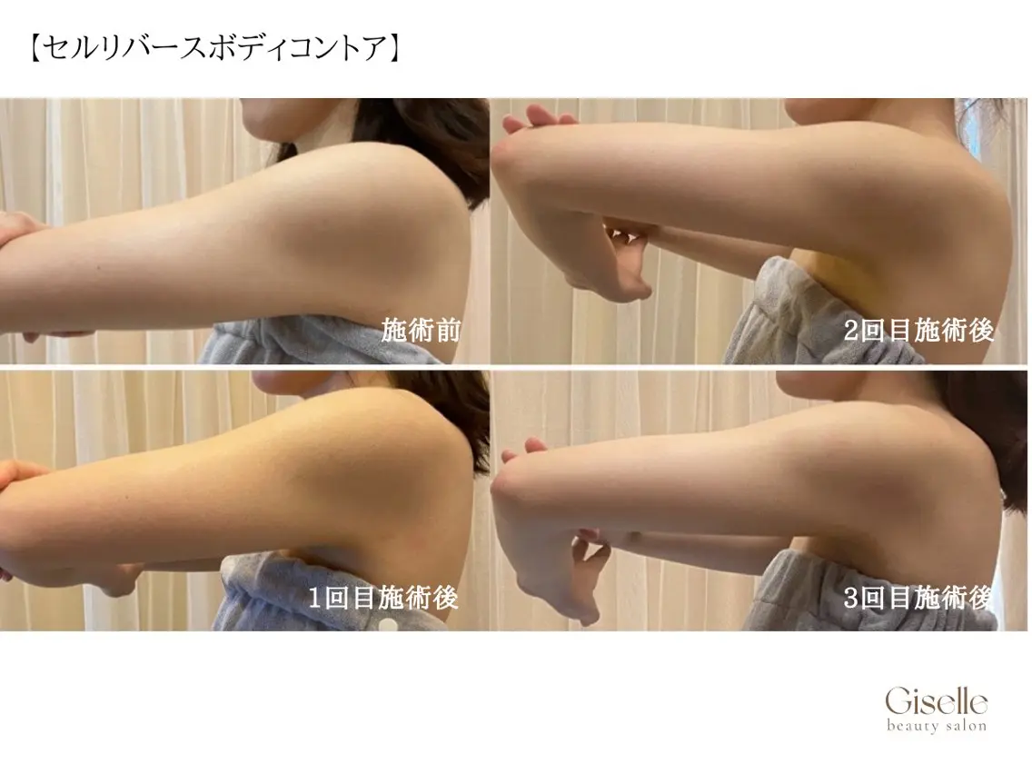 【セルリバースボディコントア】落ちにくい脂肪に◎の写真