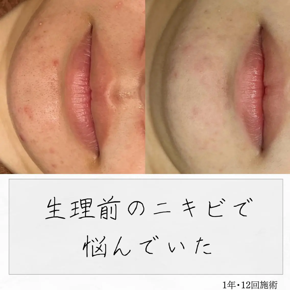 ニキビ経験者が施術 する専門サロン🌻のエステ・リラクイメージ