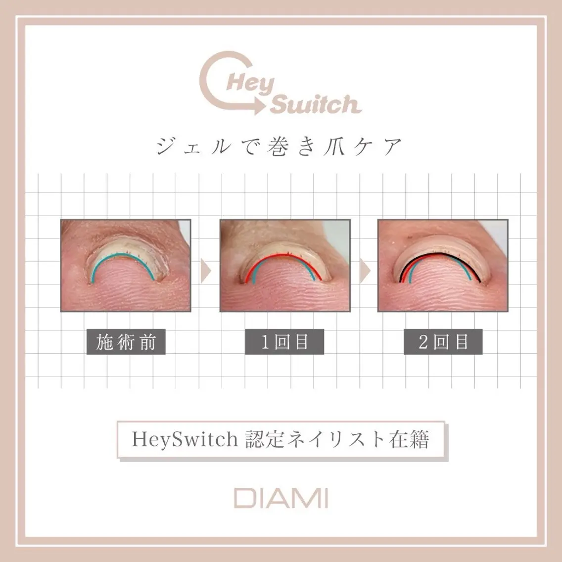 【歩くのが劇的ラクに!】巻き爪改善ケア☆ヘイスイッチ初回親指2本矯正(10本ケア + 角質ケア込)の写真