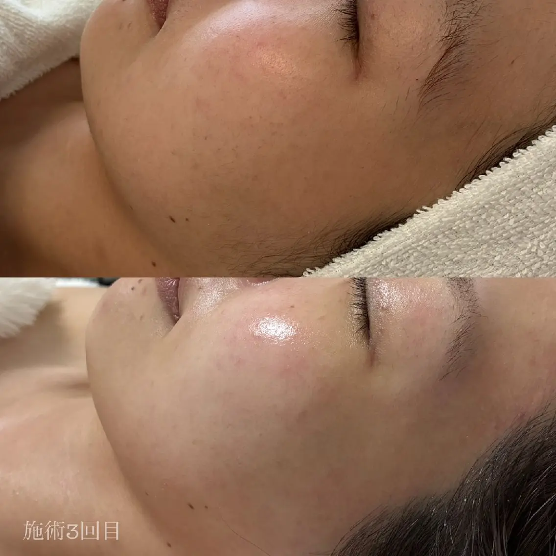 【8月限定】肌診断+毛穴引き締め水光パック通い放題!!の写真