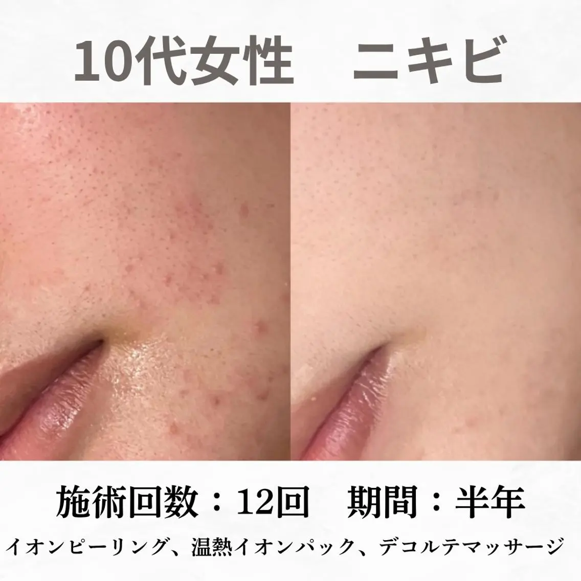 重度ニキビ専門🌷 ダウンタイムなしのエステ・リラクイメージ