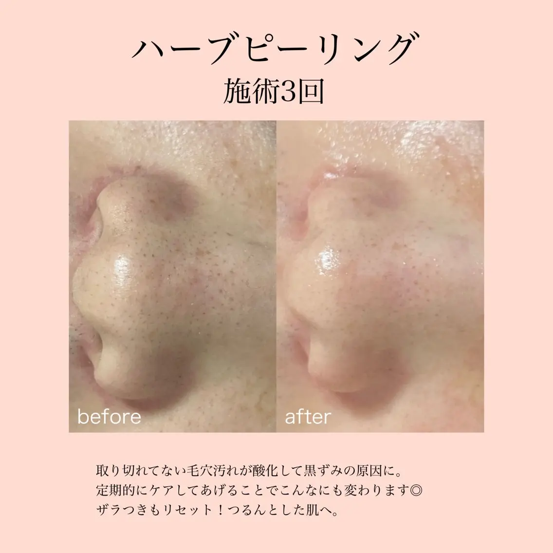 ミニモ限定価格【ニキビ/ザラつきにはこれ】ハーブピーリング、オイルデコルテ/肩/首マッサージ付き♪の写真